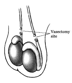 basic diagram of sutured end of vas deferens