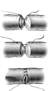 diagrammatic picture of Vasovasostomy