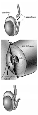 diagrammatic picture of Vasovasostomy